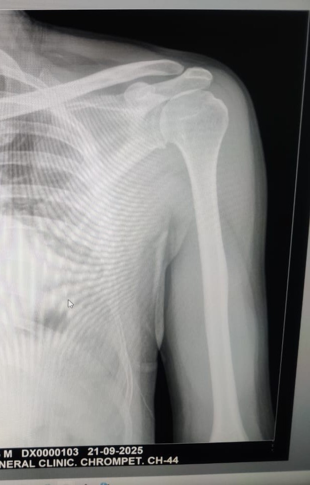 After joint replacement example